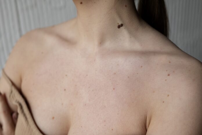 Cada 23 de mayo es el día mundial de la concientización del melanoma