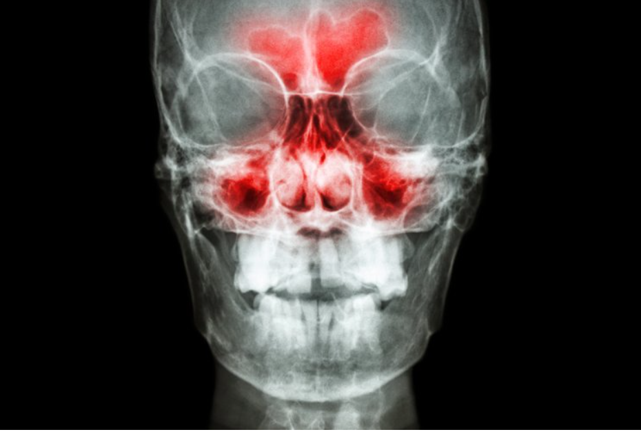 Existen varios exámenes para detectar la presencia de sinusitis